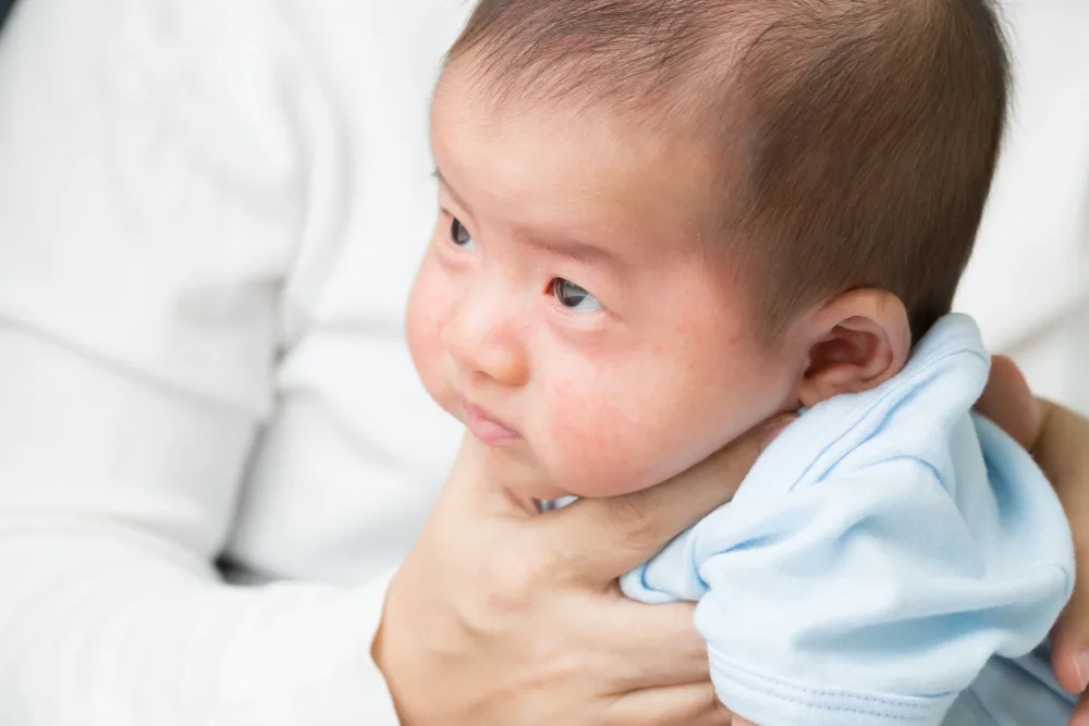 DERMATITIS ATOPIK ANAK: KENALI, CEGAH, DAN KELOLA DENGAN TEPAT